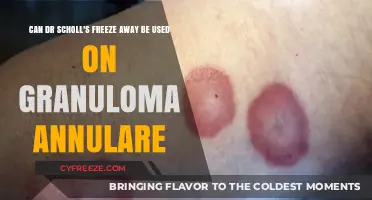 Can Dr. Scholl's Freeze Away Treat Granuloma Annulare? Find Out