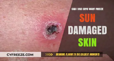 Cryo Wart Freeze for Sun Damaged Skin: Safe or Risky?