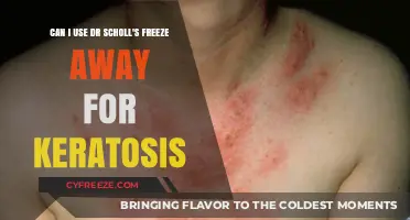 Using Dr. Scholl's Freeze Away for Keratosis: Safe and Effective?