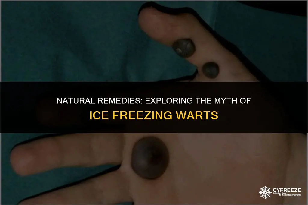 can ice freeze a wart