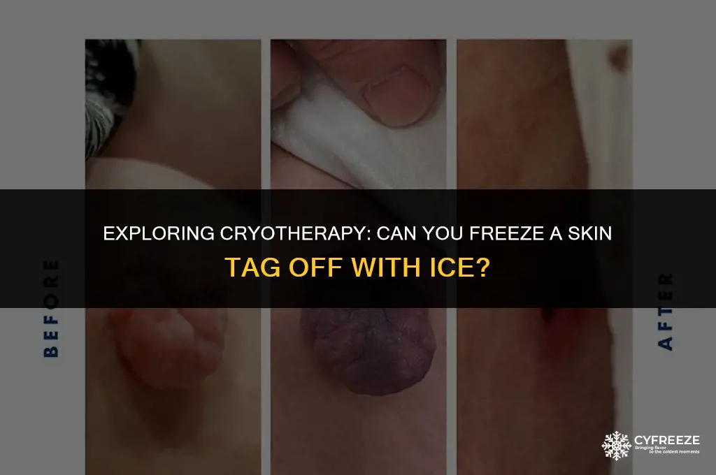 can you freeze a skin tag off with ice