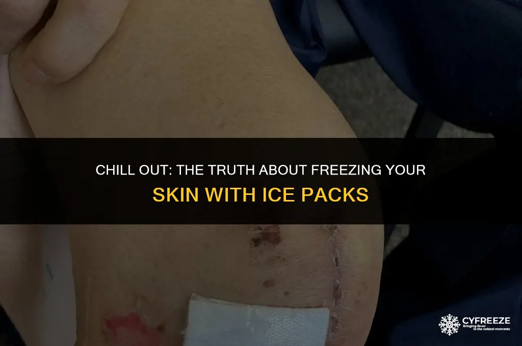can you freeze your skin with an ice pack