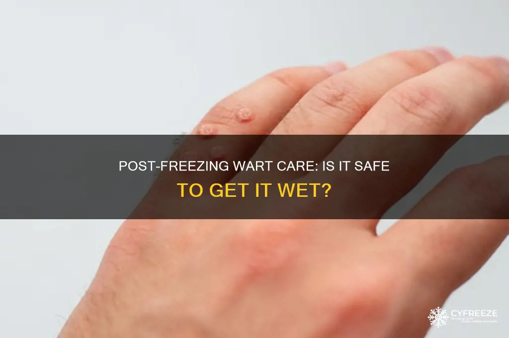 can you get a wart wet after freezing