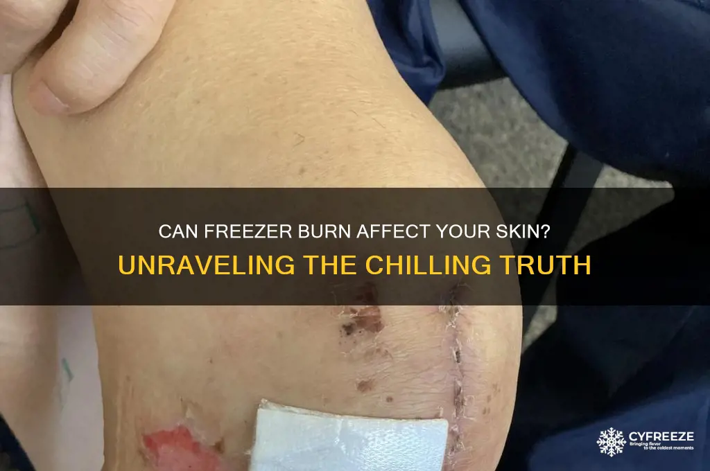 can you get freezer burn on your skin