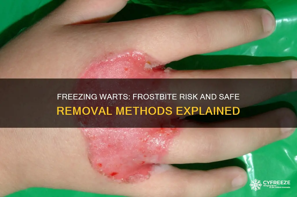 can you get frostbite from freezing a wart