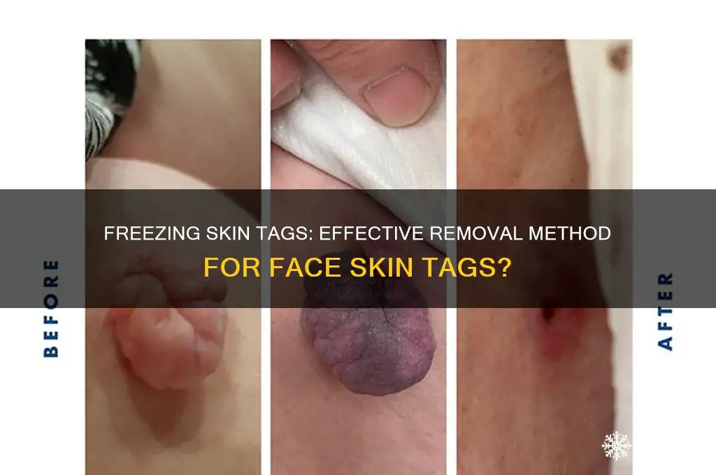 can you get rid of face skin tag by freezing