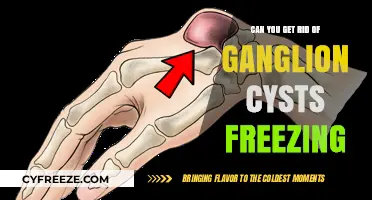 Freezing Ganglion Cysts: Effective Removal or Temporary Relief?