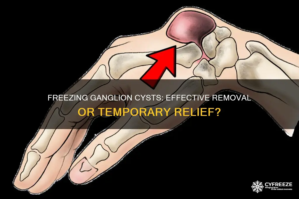can you get rid of ganglion cysts freezing