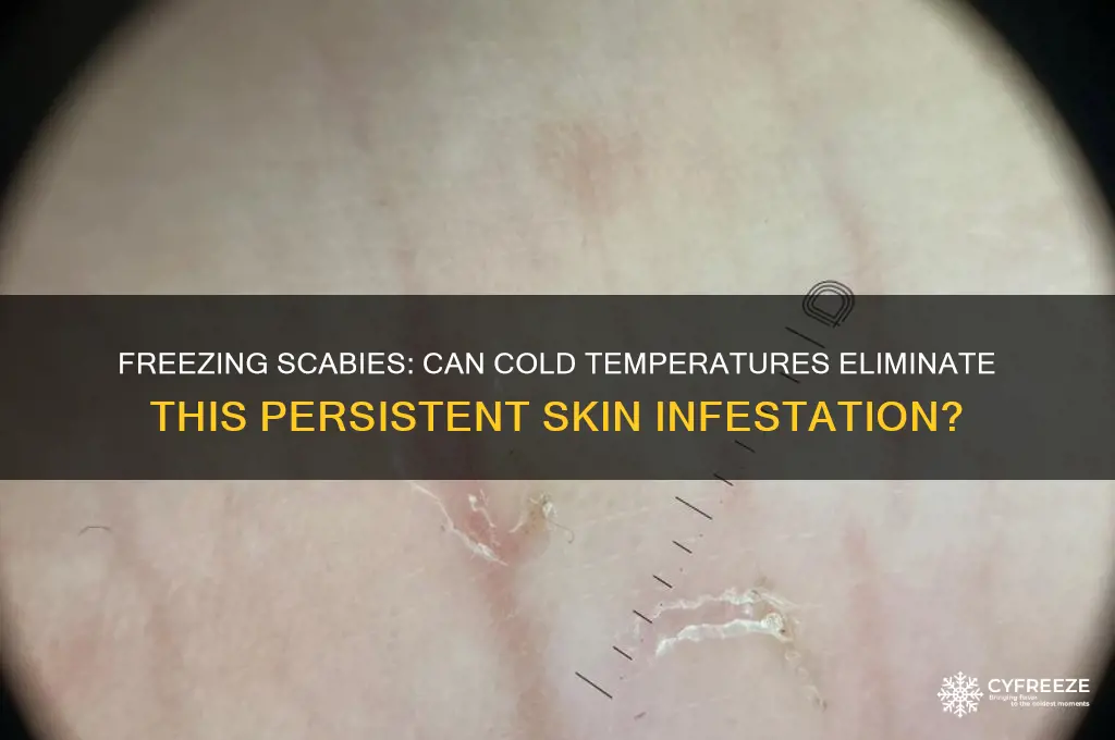 can you get rid of scabies by freezing it out