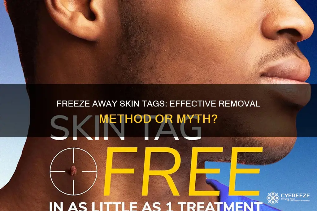 can you get rid of skin tags with freeze away