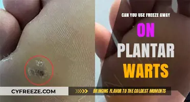 Using Freeze Away on Plantar Warts: Safe and Effective Treatment?