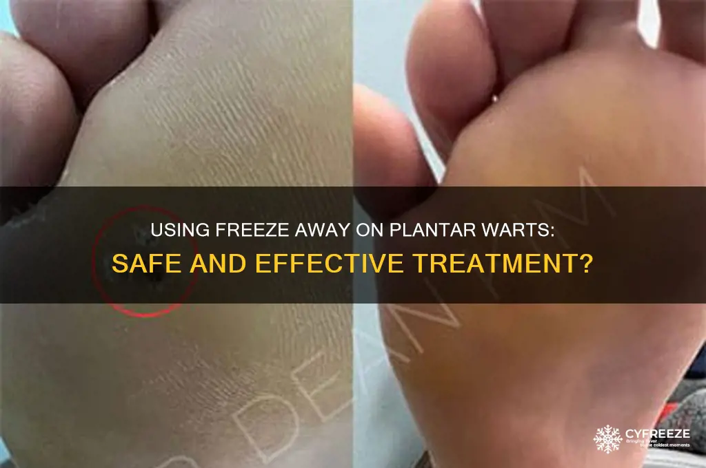 can you use freeze away on plantar warts