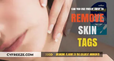 Freeze Away for Skin Tags: Effective Removal Method or Myth?