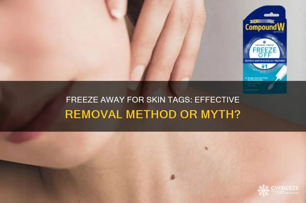 can you use freeze away to remove skin tags