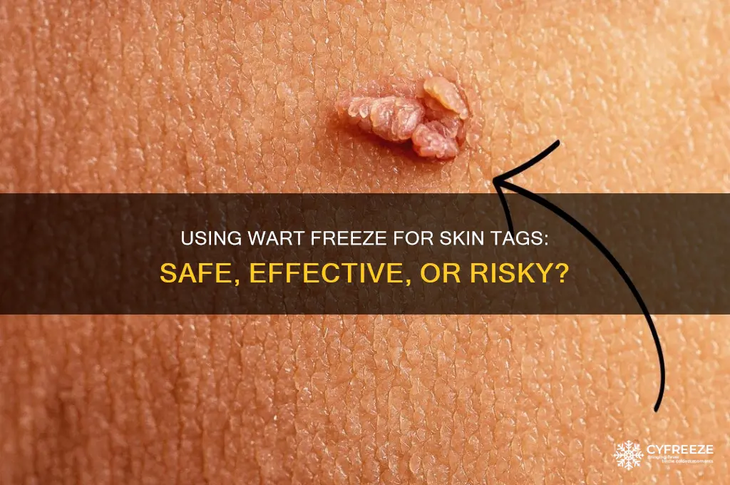 can you use wart freeze for skin tags