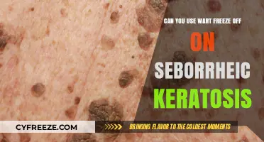 Wart Freeze Off for Seborrheic Keratosis: Safe and Effective Treatment?