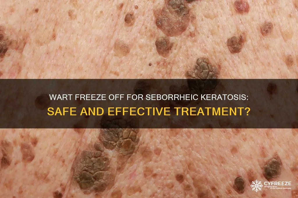 can you use wart freeze off on seborrheic keratosis