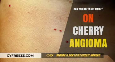 Wart Freeze for Cherry Angioma: Safe Treatment Option or Risky Move?