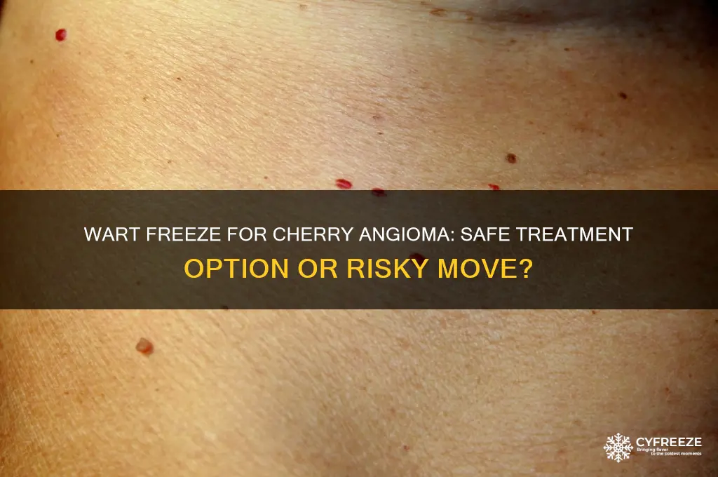 can you use wart freeze on cherry angioma