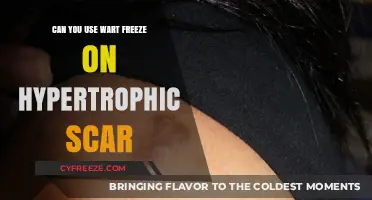 Using Wart Freeze on Hypertrophic Scars: Safe or Risky Treatment?