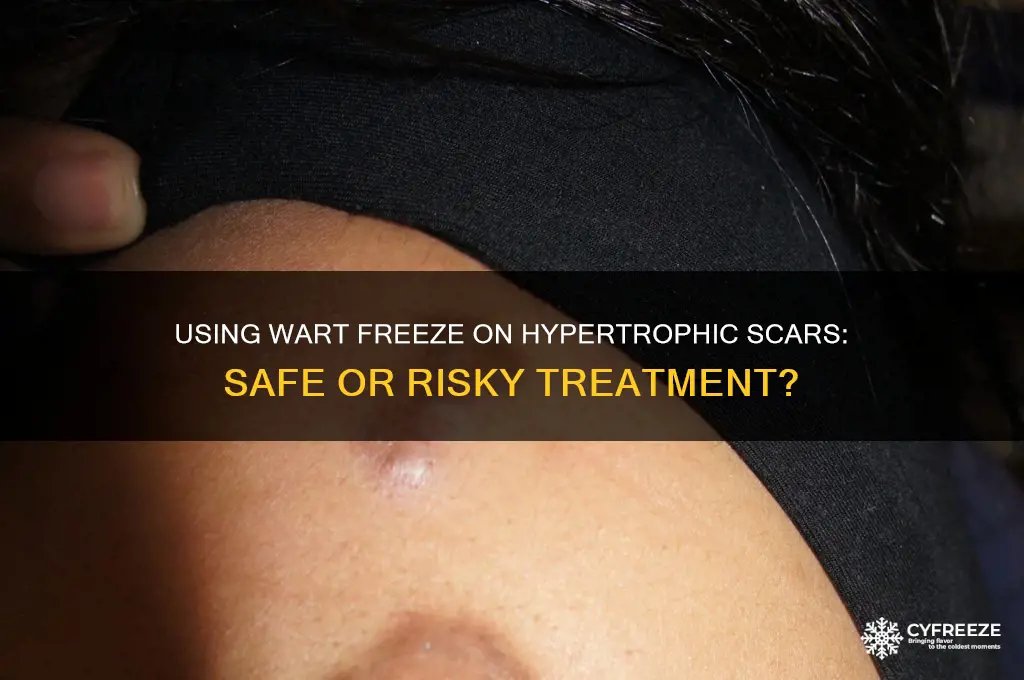 can you use wart freeze on hypertrophic scar
