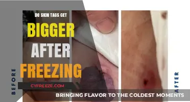 Do Skin Tags Grow Larger After Cryotherapy? Facts and Insights