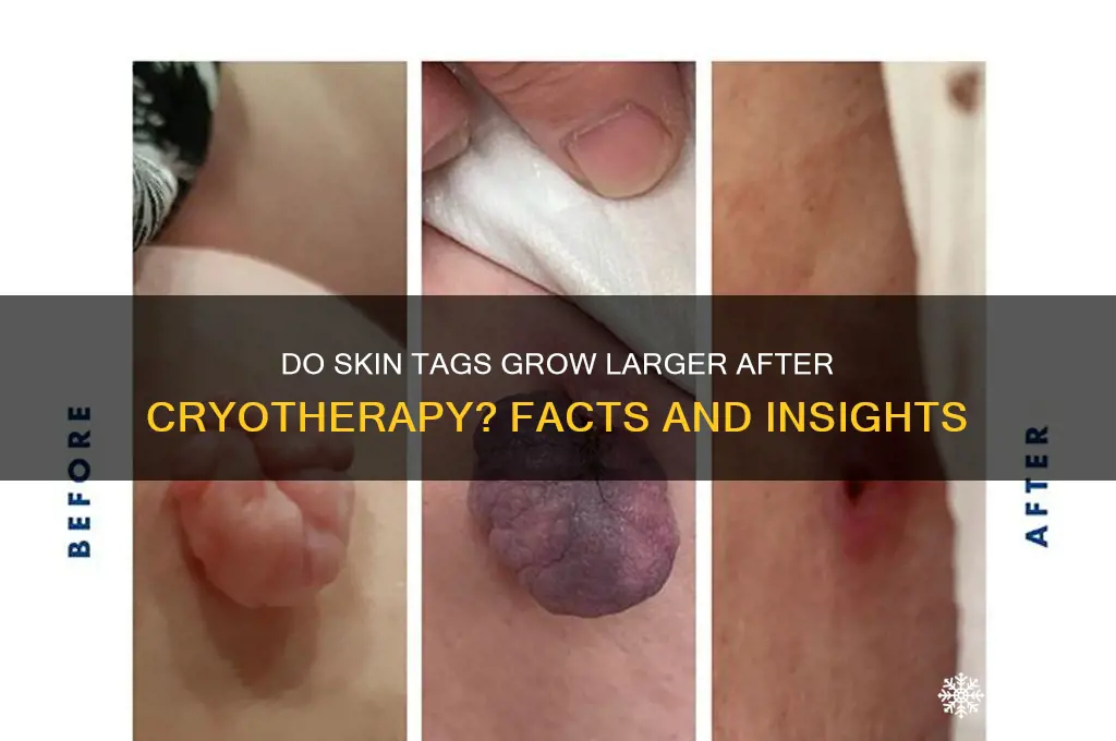 do skin tags get bigger after freezing