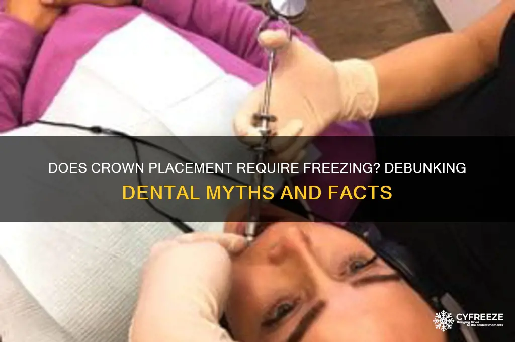 do you need freezing to get a crown