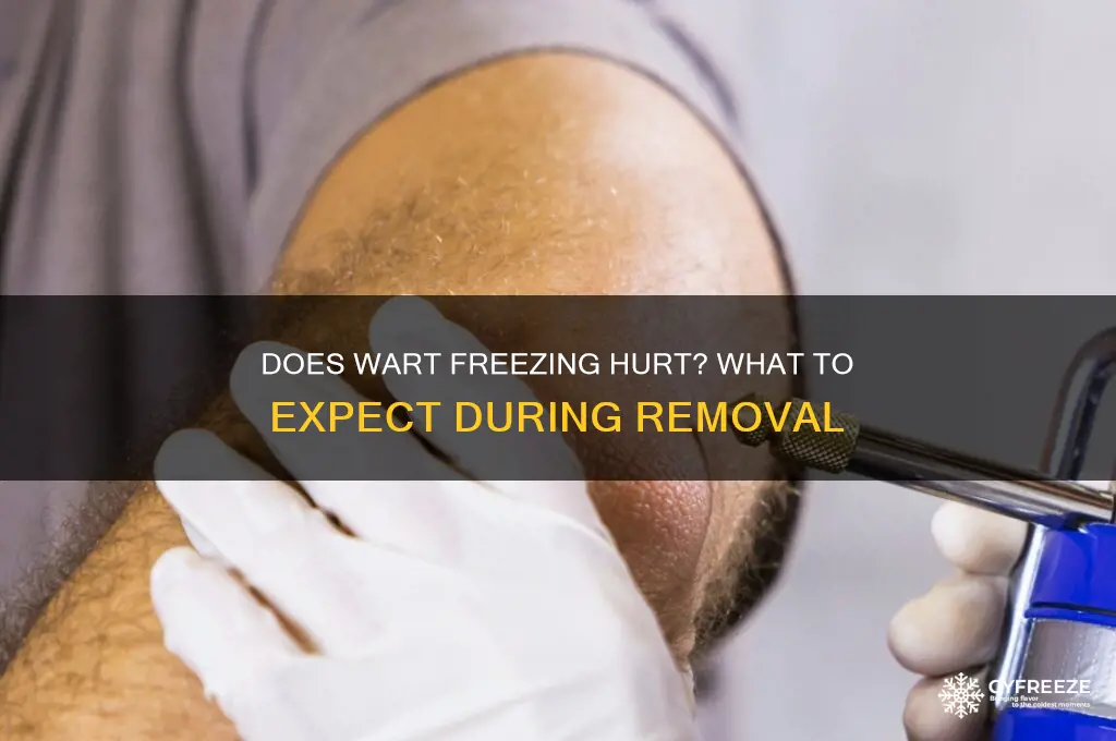 does it hurt to get a wart freeze off