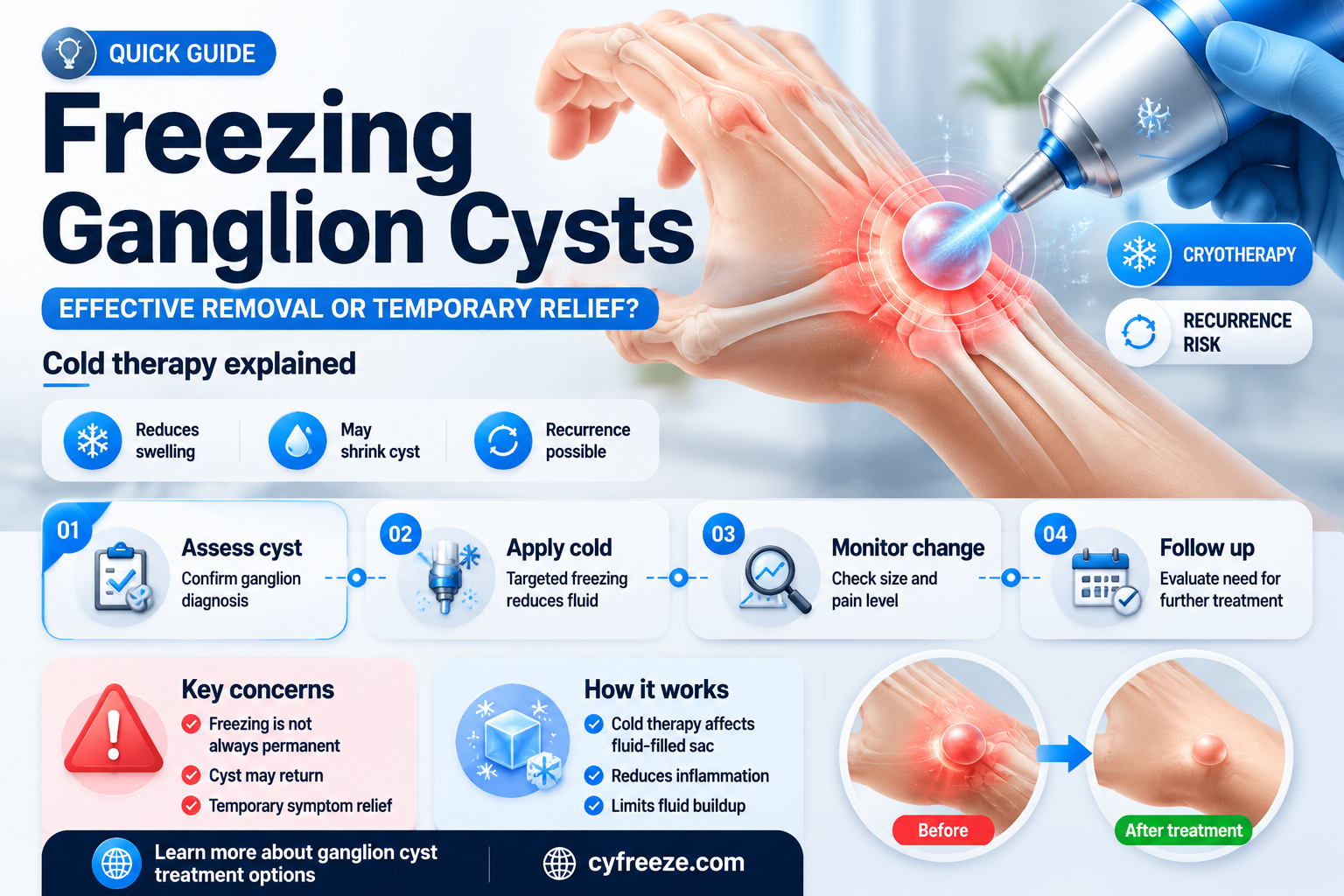 can you get rid of ganglion cysts freezing