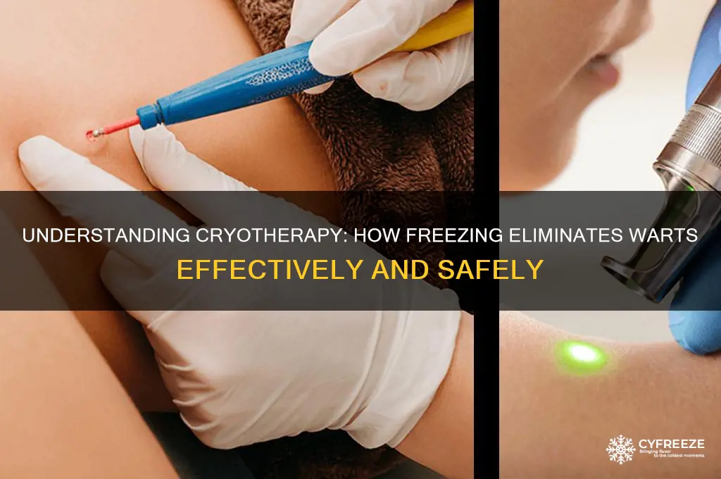 how does freezing a wart get rid of it