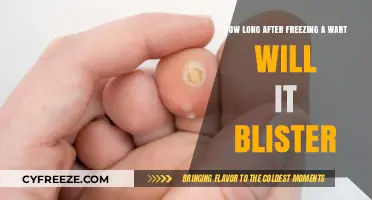 Understanding Wart Freezing: When to Expect Blistering and Healing
