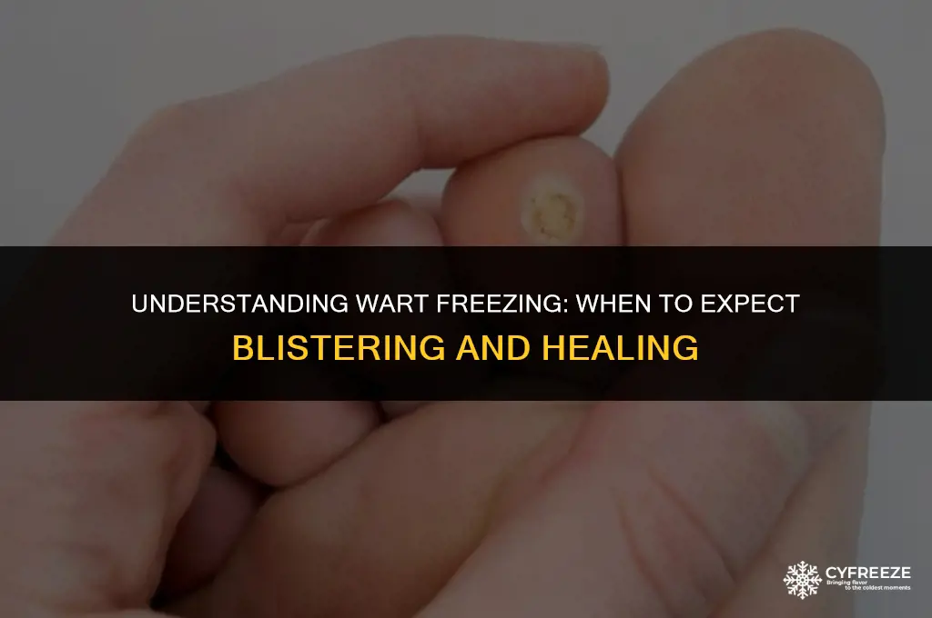 how long after freezing a wart will it blister