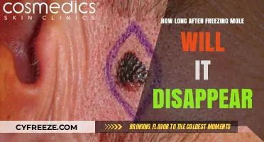 Vanishing Moles: The Timeline of Frozen Mole Removal