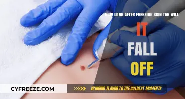 Understanding Skin Tag Removal: The Freezing Process and What to Expect