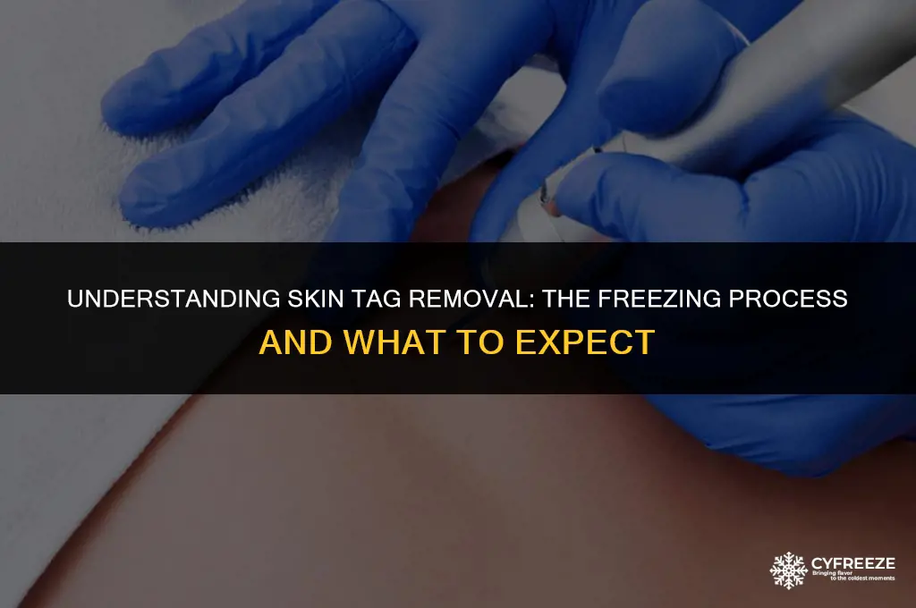 how long after freezing skin tag will it fall off
