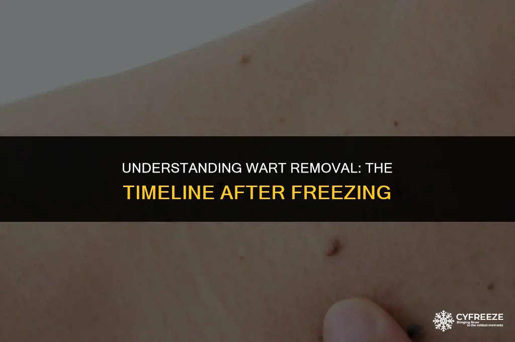how long after freezing wart will it disappear
