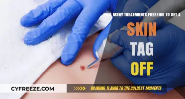 Effective Freezing Treatments to Safely Remove Skin Tags: A Guide