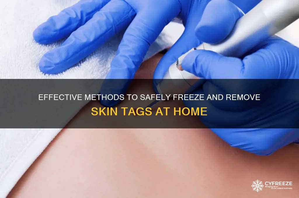 how to get freeze skin tags