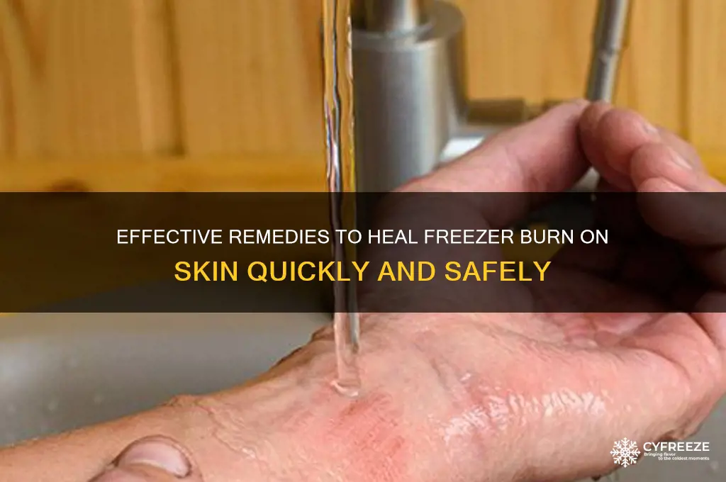 how to get rid of a freezer burn on skin