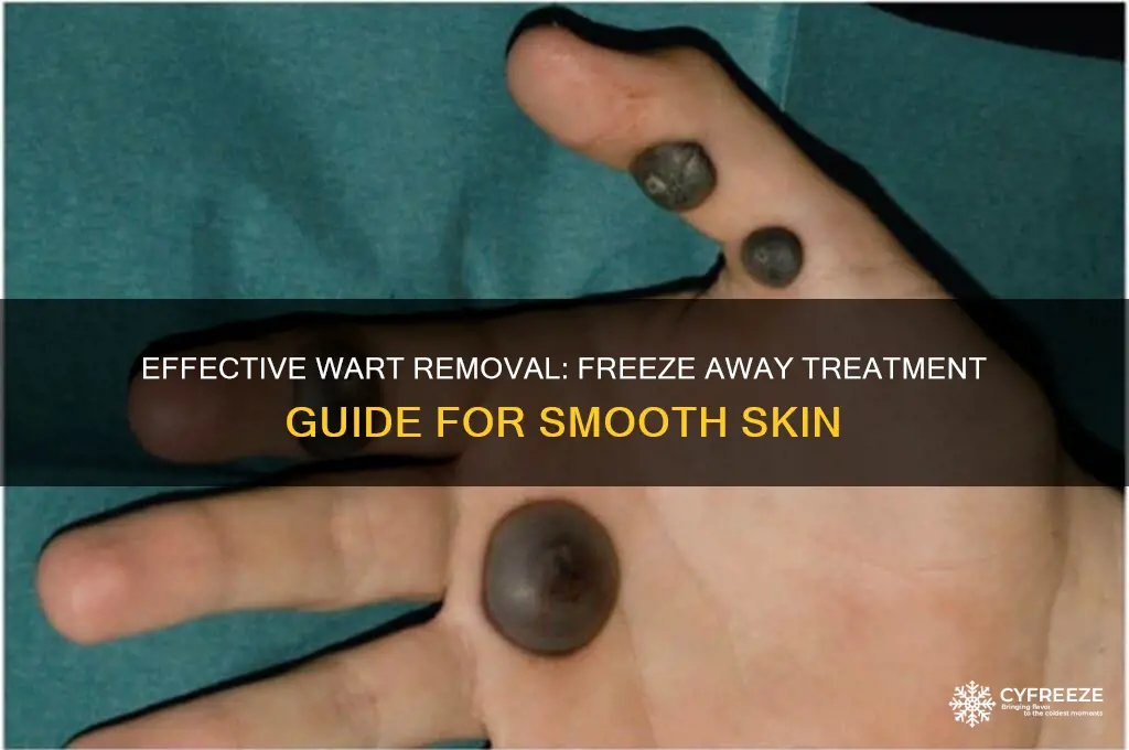 how to get rid of wart with freeze away