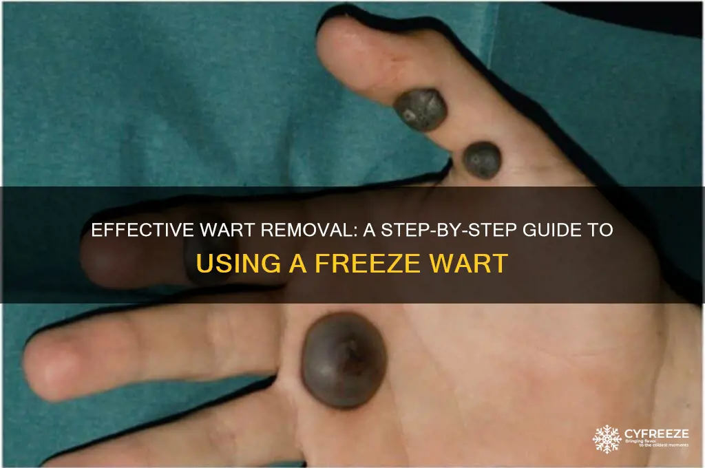 how to use a freeze wart