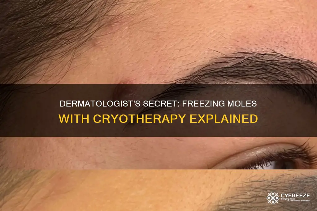 what do dermatologist use to freeze moles