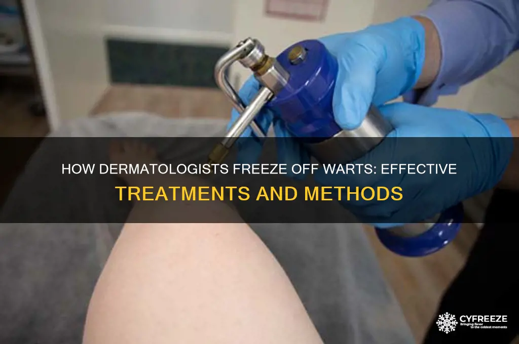 what do dermatologist use to freeze off warts