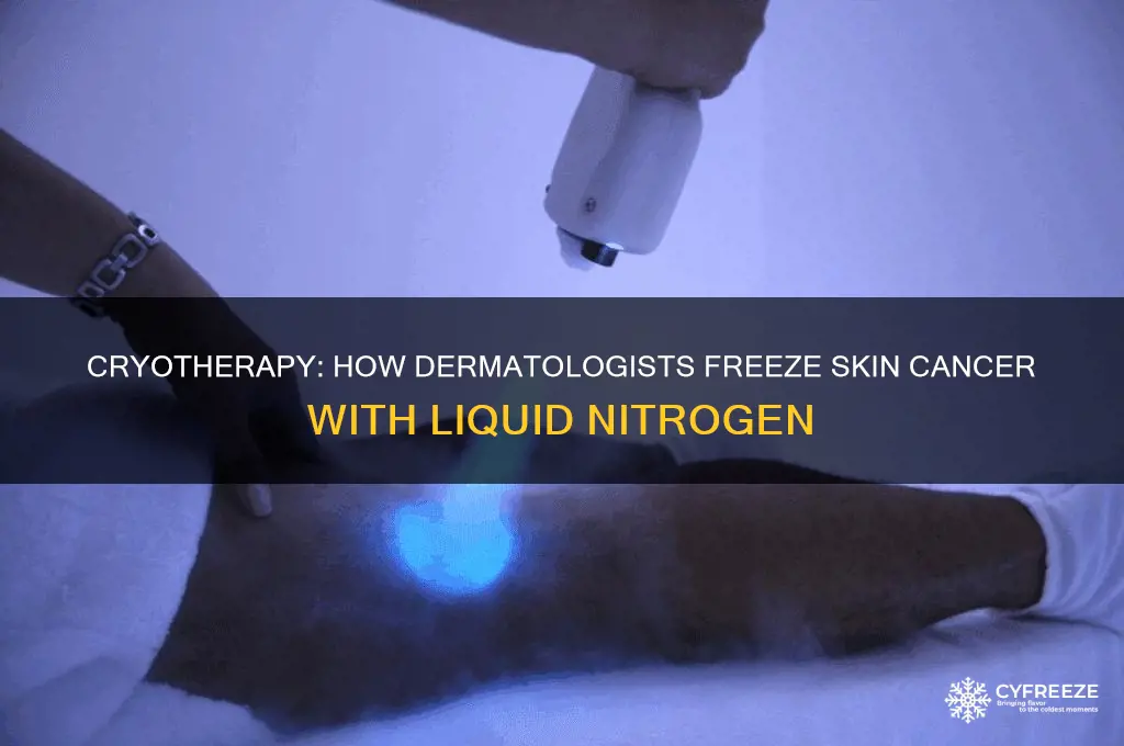 what do dermatologists use to freeze skin cancer