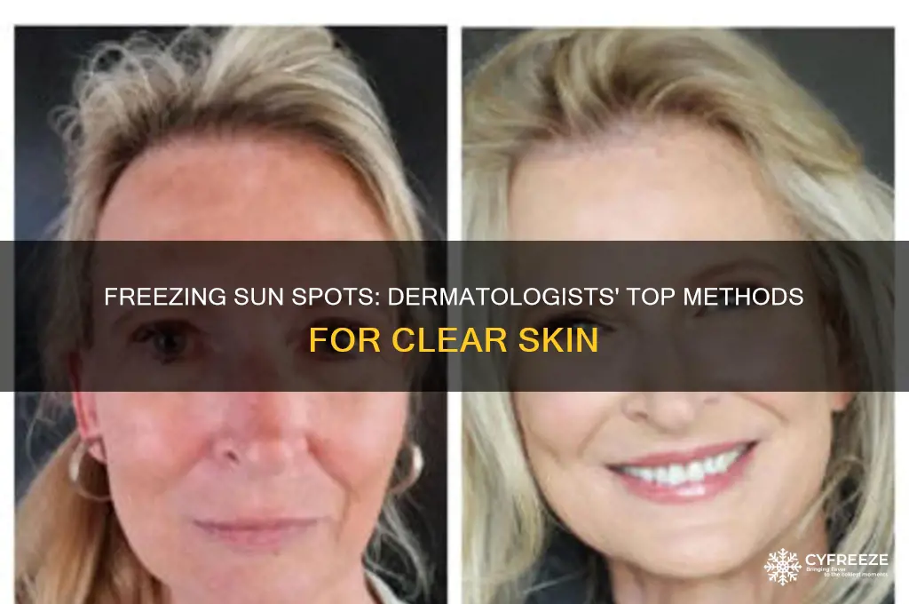 what do dermatologists use to freeze sun spots