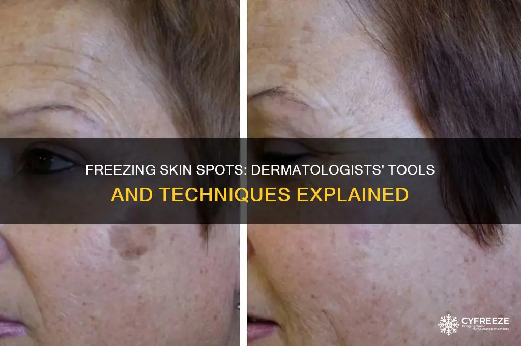 what do dermotoligist use to freeze off skin spots
