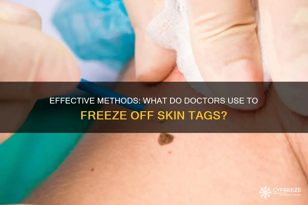 what do doctors use to freeze off skin tags