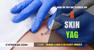 Understanding Skin Tag Removal: The Freezing Technique Explained