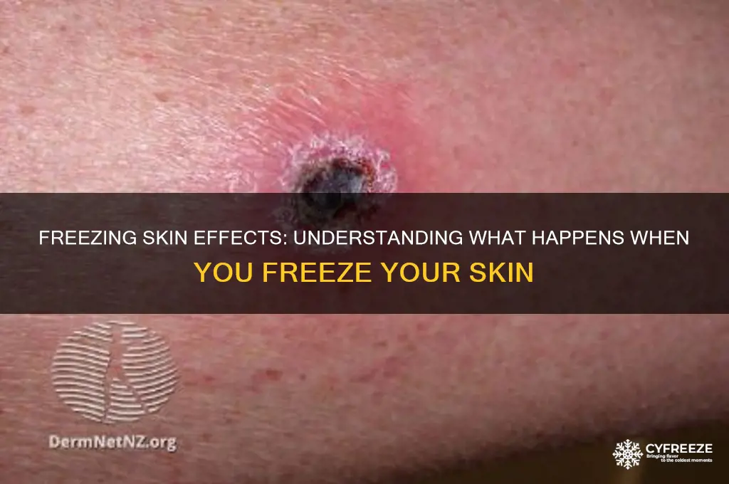 what do you get when you freeze on you rskin